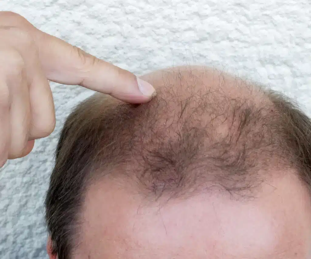 PRP and Hair Transplant Combination Candidate