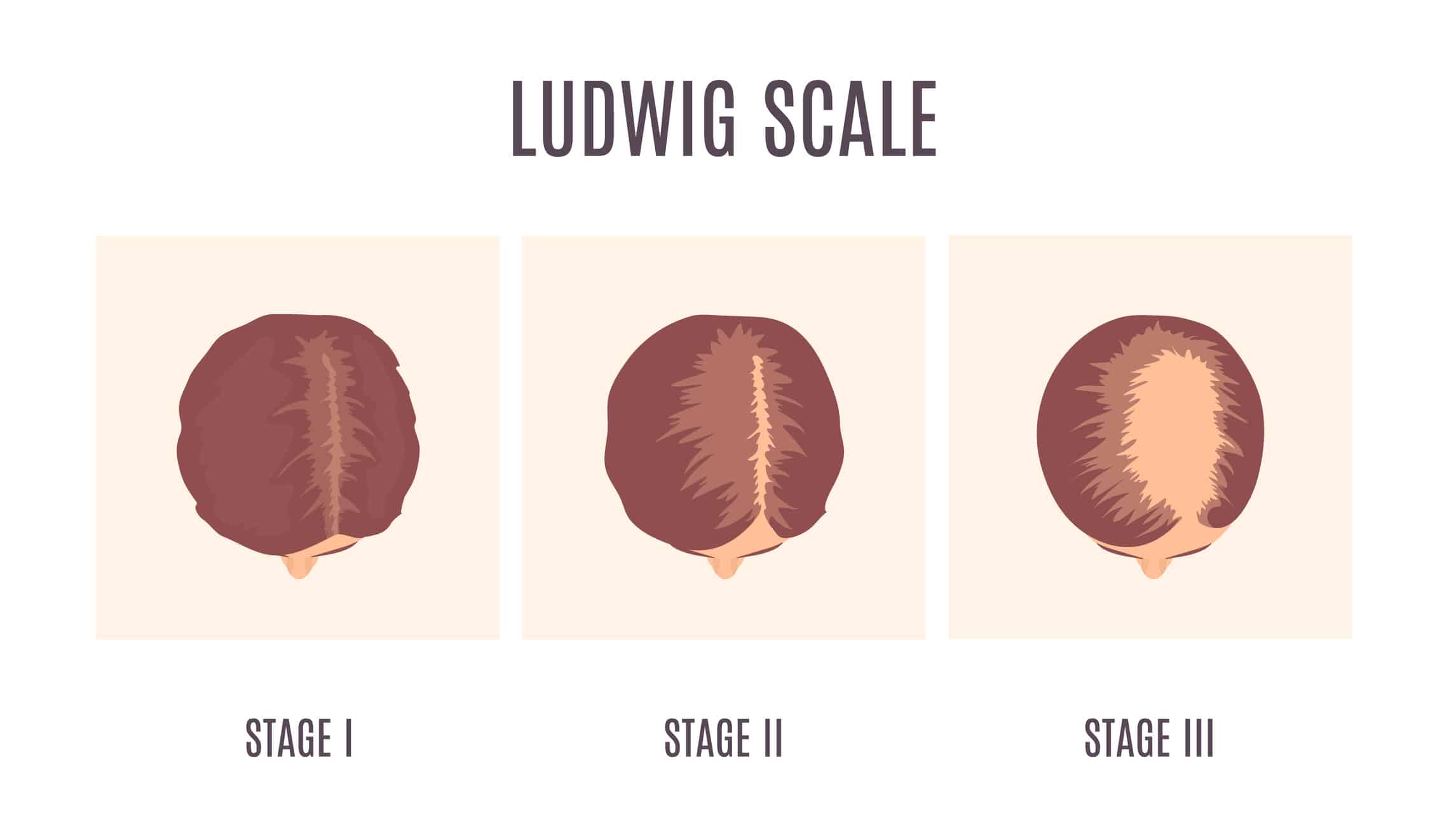 Illustration of the Ludwig Scale from Hair GP, highlighting three stages of her female pattern baldness. Stage I: Minimal thinning. Stage II: Increased thinning and widening of the part. Stage III: Advanced thinning with significant hair loss on the top of her scalp.